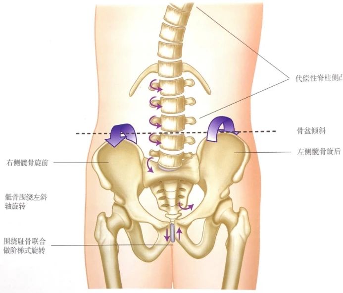 腰椎间盘突出不背锅，有一种痛其实叫做“骨盆旋移综合征”